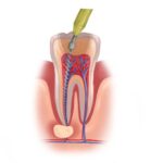 Drawing of root canal treatment