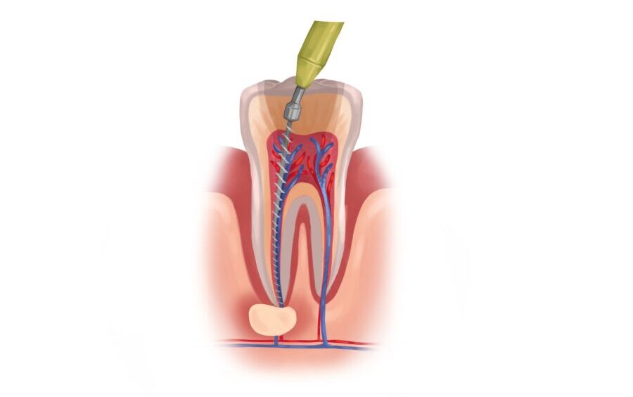 Drawing of root canal treatment at dentist in hermitage