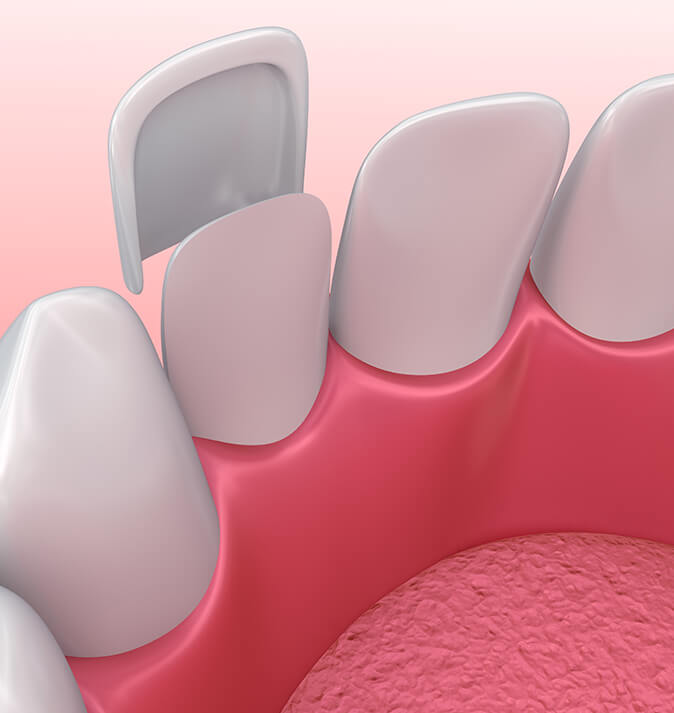 illustration of a dental veneer