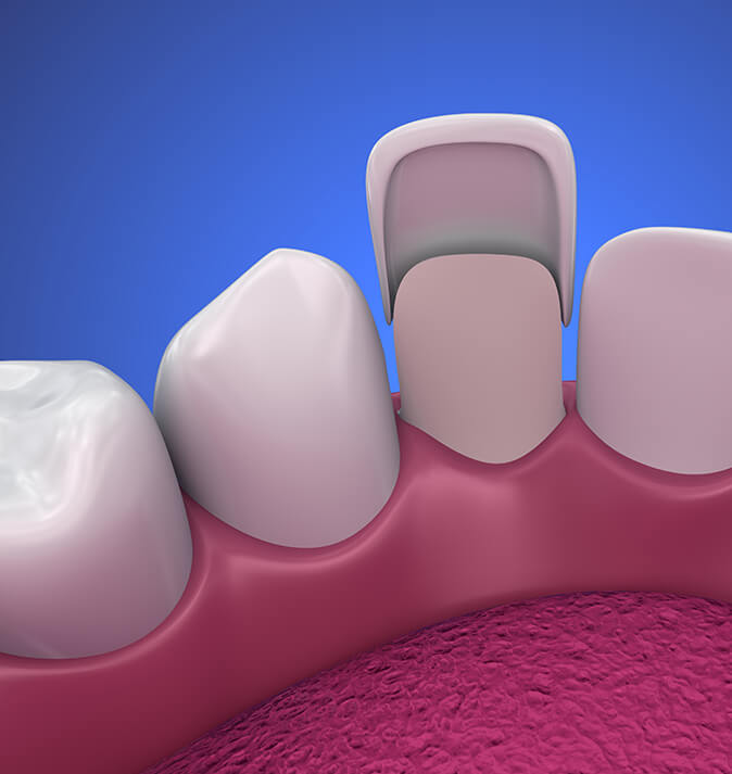 illustration of a dental veneer