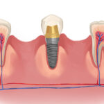 Model showing a dental implant in-between natural teeth.