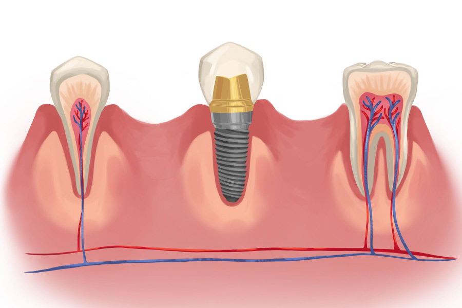 Model showing a dental implant in-between natural teeth.