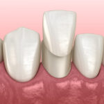 dental veneers, cosmetic dentistry, dentist in hermitage