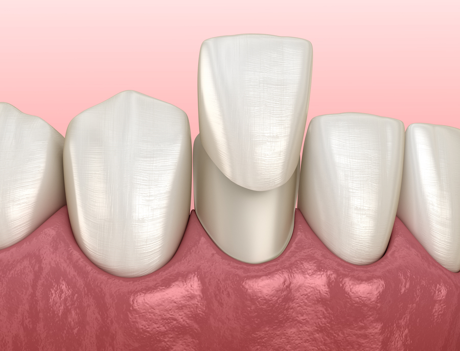 dental veneers, cosmetic dentistry, dentist in hermitage