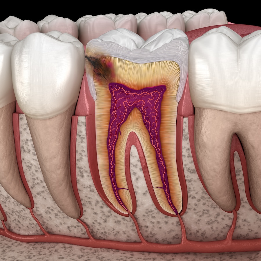 untreated cavities, cavity treatment, dental health, Hermitage TN dentist, tooth decay prevention, oral health risks, cavity risks