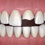 chipped tooth on vacation, dental emergency when you chip a tooth