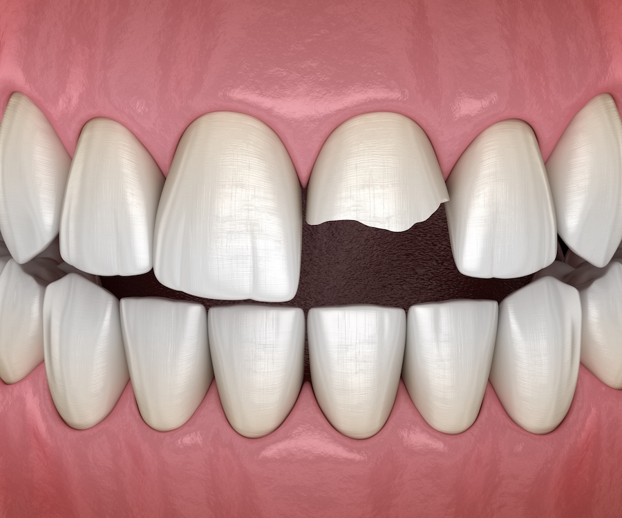 chipped tooth on vacation, dental emergency when you chip a tooth