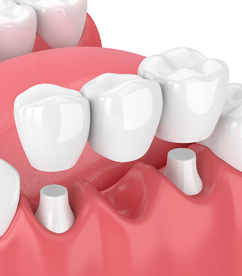 illustration of a dental bridge