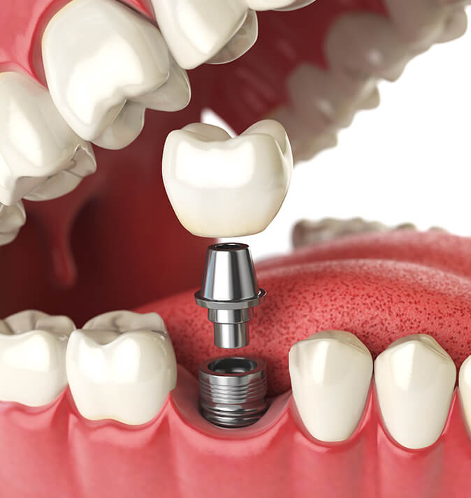 illustration of a dental implant