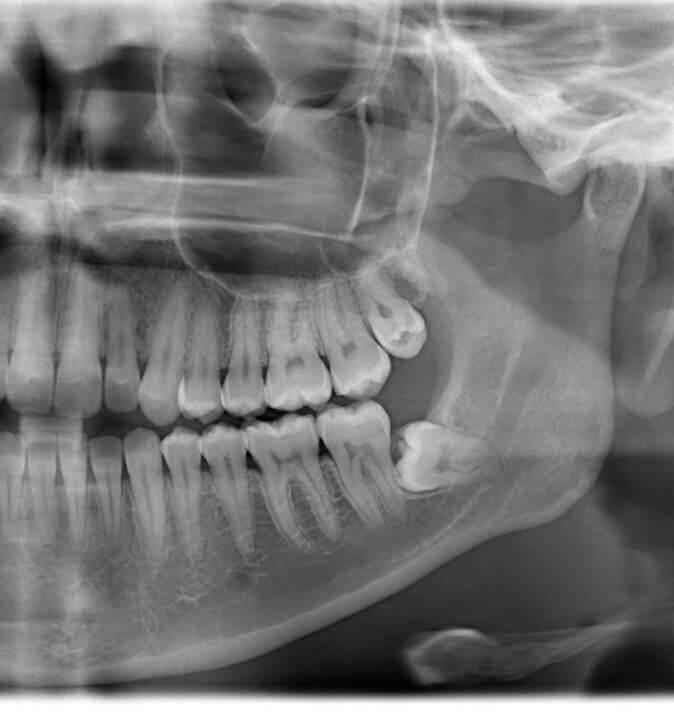 x-ray showing impacted wisdom teeth
