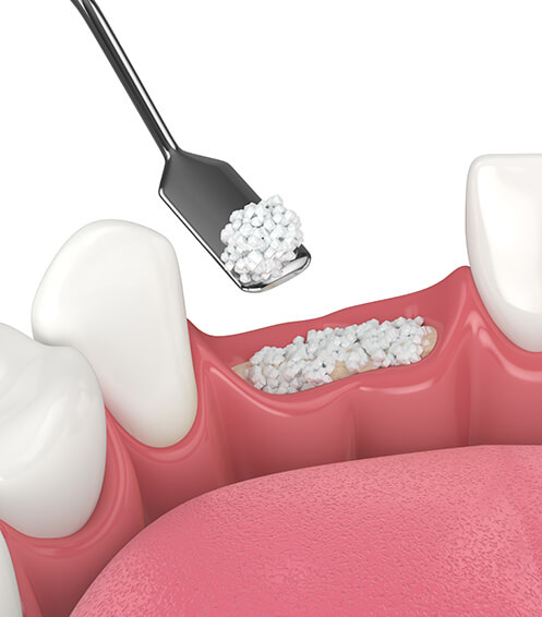 illustration of a bone graft procedure