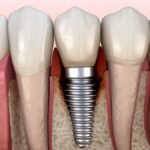 can implants get cavities? they can get periimplantitis