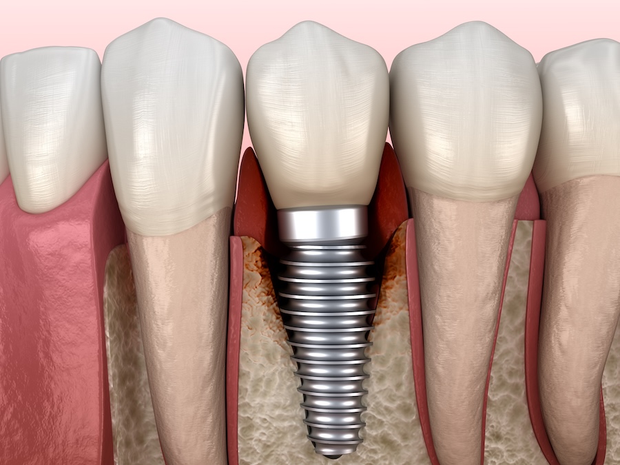 can implants get cavities? they can get periimplantitis