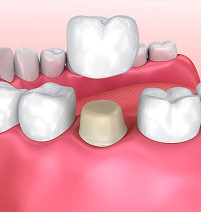 illustration of dental crown