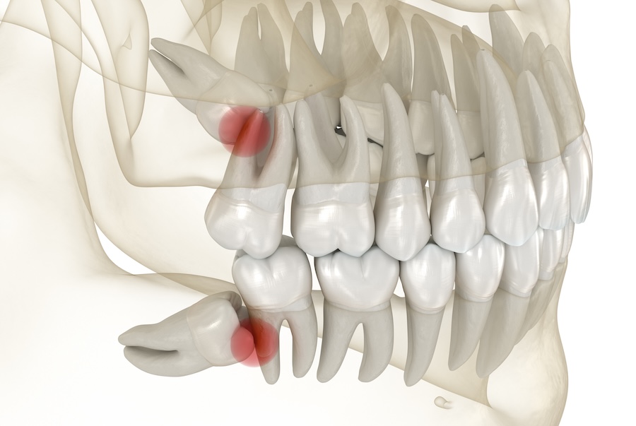 wisdom teeth removal tips