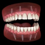 implant supported denture, all on 4