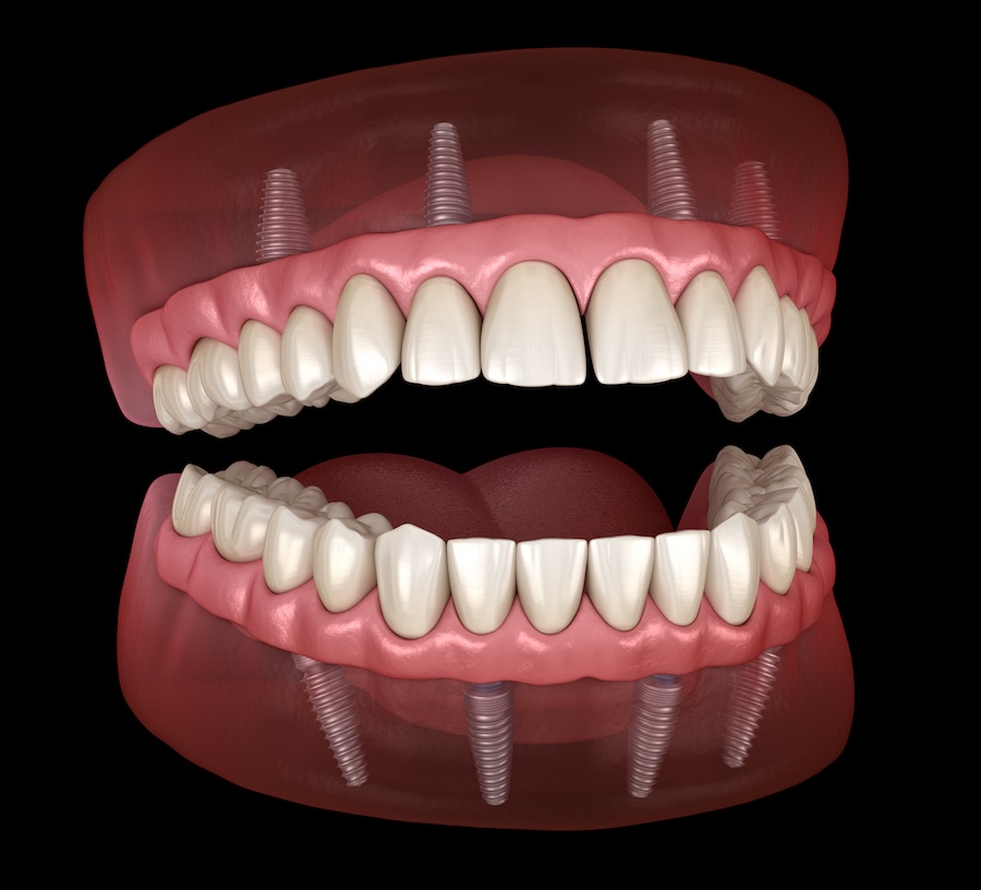 implant supported denture, all on 4