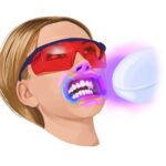 woman getting teeth whitening before dental veneers