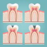 dental filling, dental cavity progression