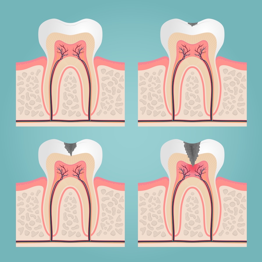 dental filling, dental cavity progression